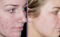 Криомассаж — показания и противопоказания к процедуре