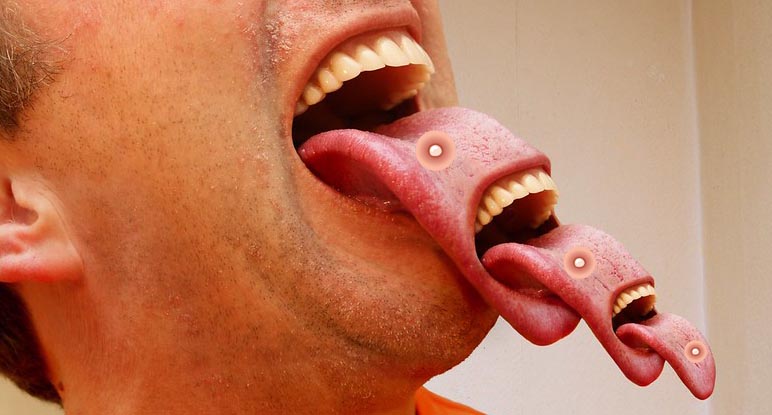 прыщ на языке 7