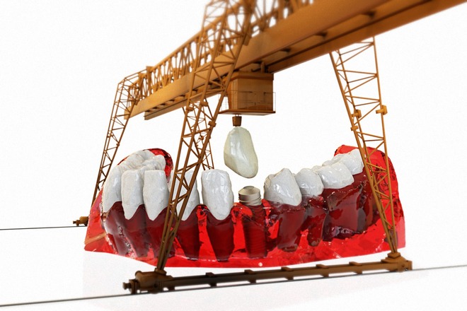 Сон о зубных имплантатах