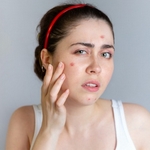 Девушка обеспокоена появлением прыщей