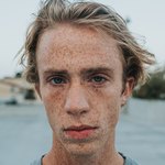 Родинку не всегда удается рассмотреть