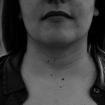 У женщины много родинок на шее