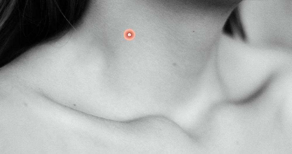 прыщ на шее 7