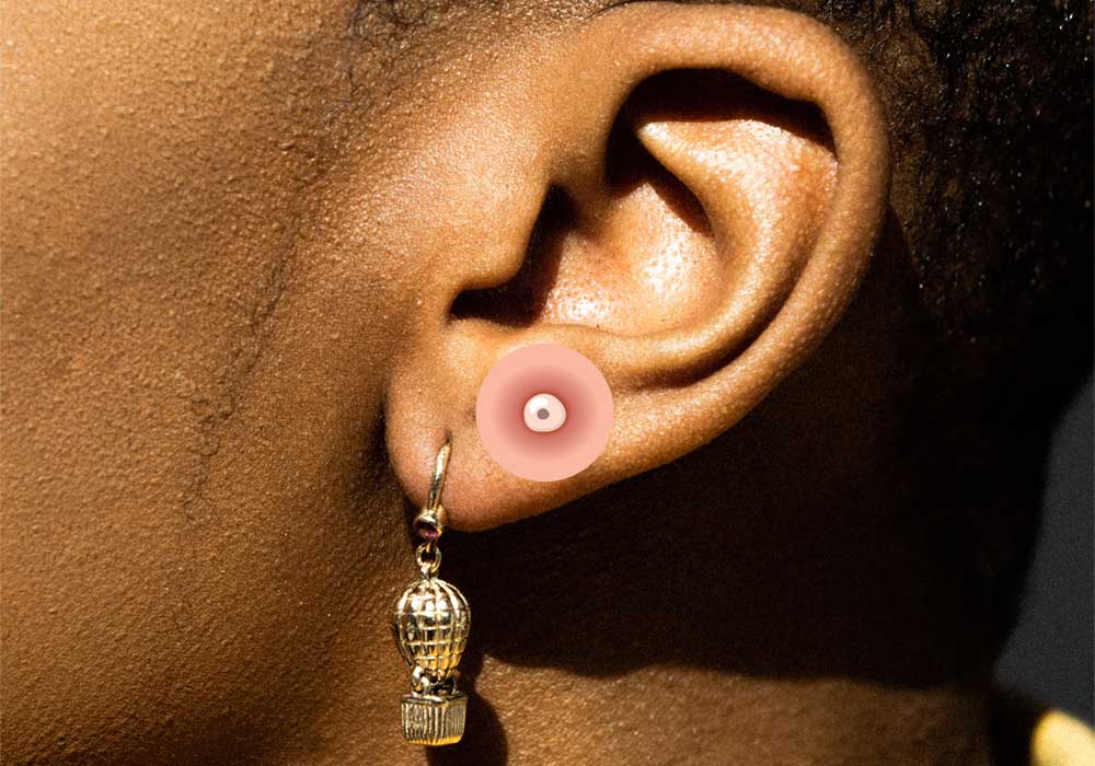 прыщ в ухе 4