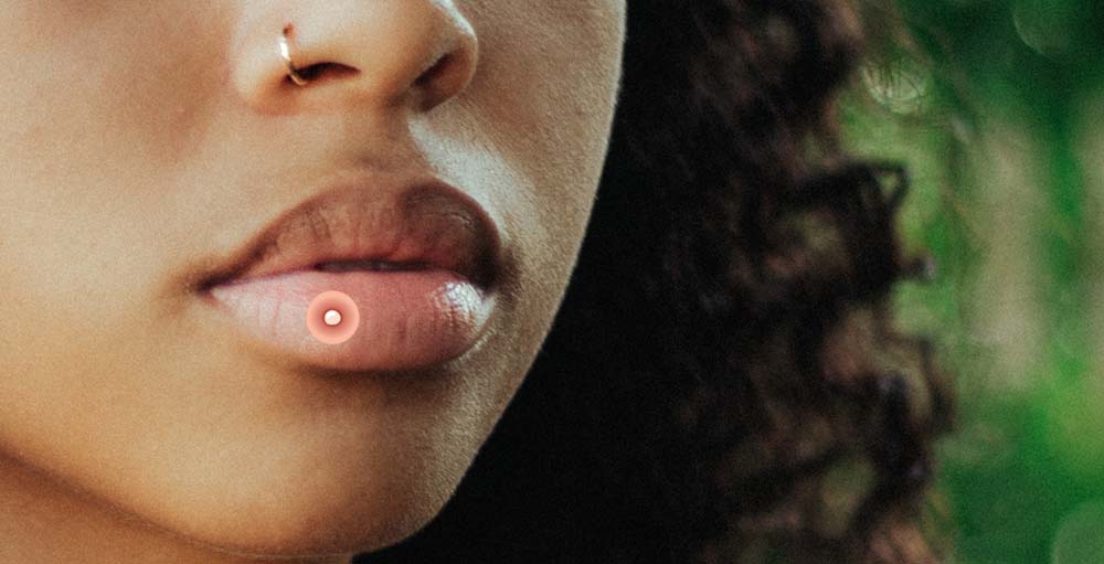 прыщ на губе 5