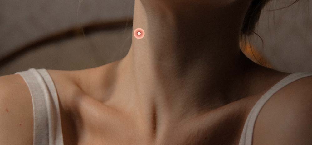 прыщ на шее 8