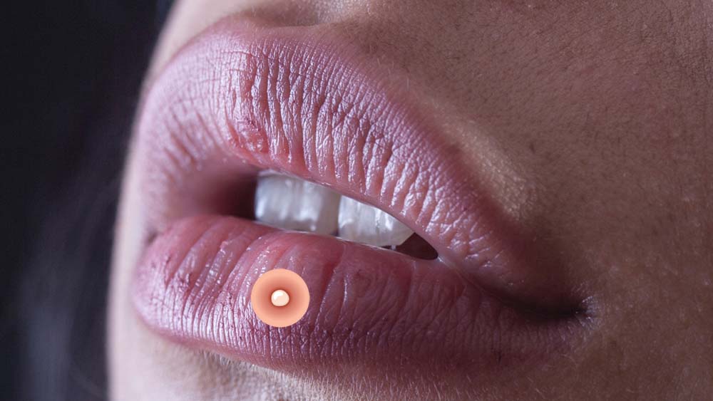 прыщ на губе 9