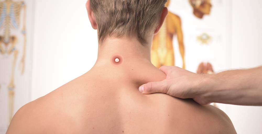 прыщ на шее 5