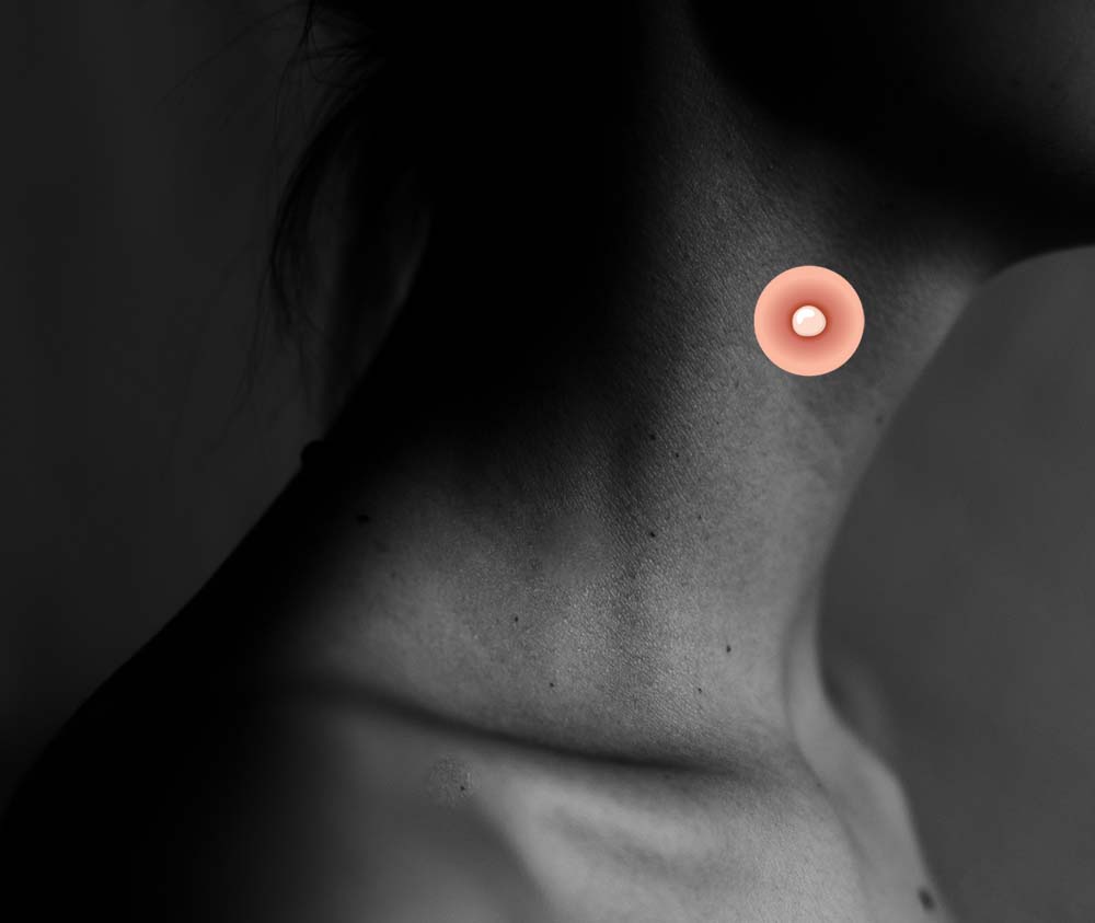 прыщ на шее 4