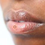 прыщ на губе 4
