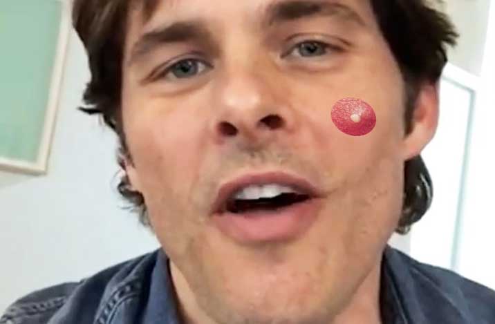 на левой щеке5