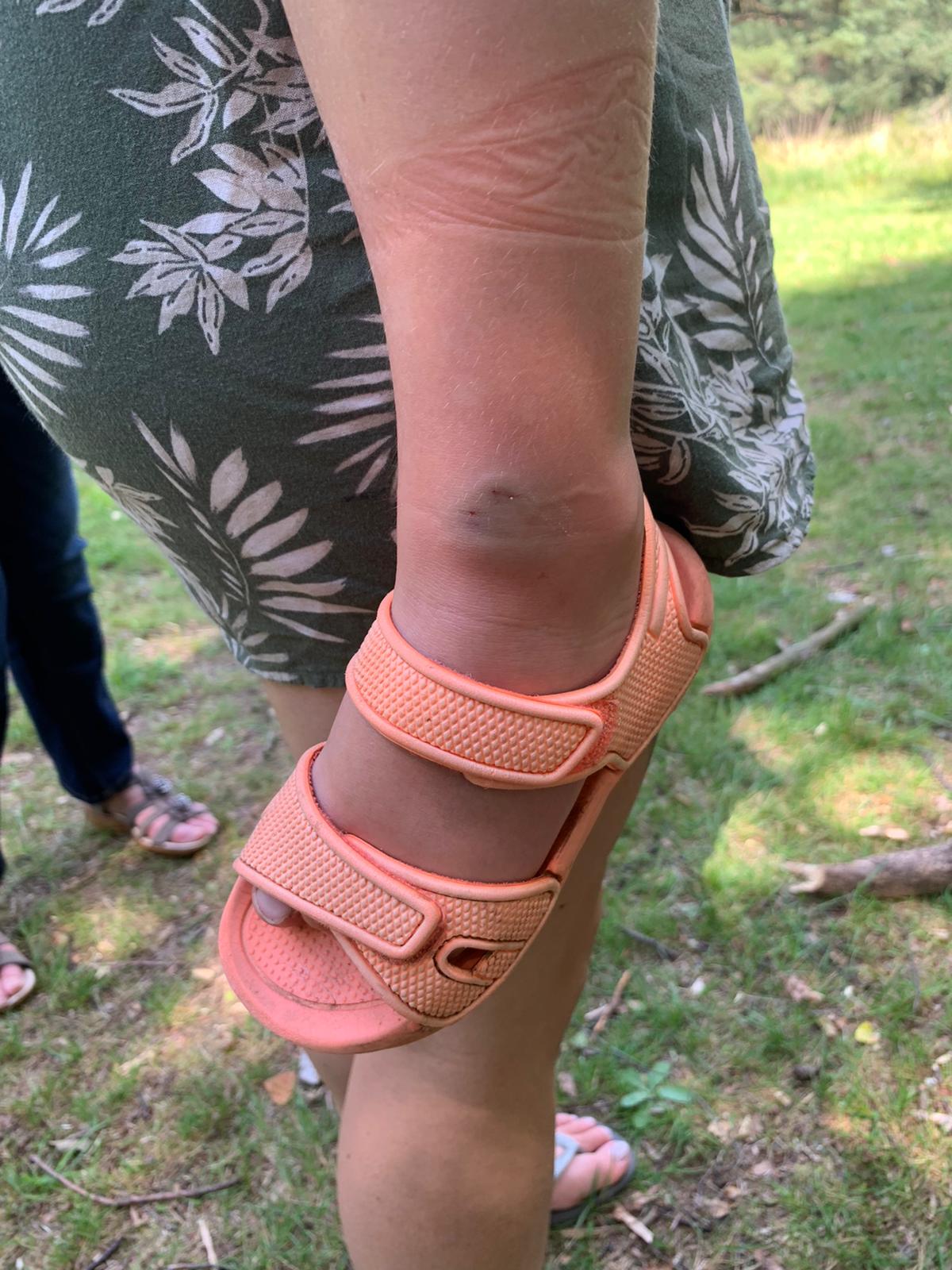 нога ребенка с укусом ребенка