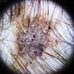 родинка на голове 7