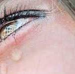 слезятся глаза 4