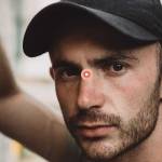 прыщ на переносице 2