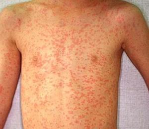 Кожное заболевание