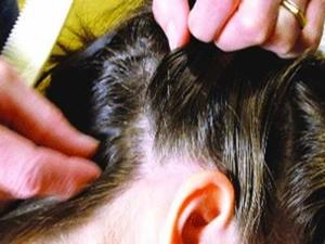 Вши в голове у девушки